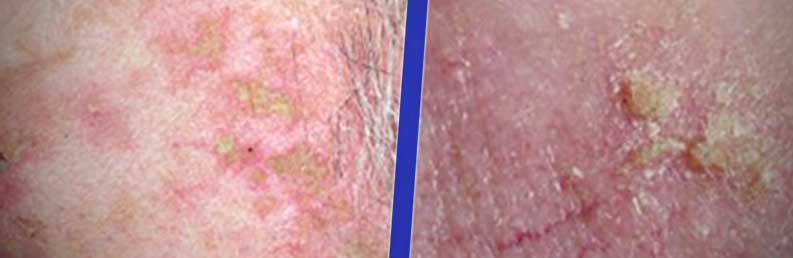 actinic keratosis skin spots
