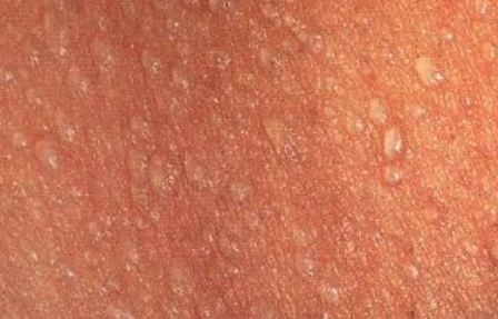 prickly heat baby skin rash