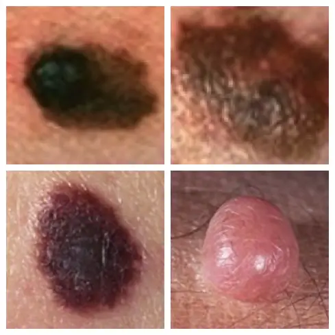 malignant melanoma pictures
