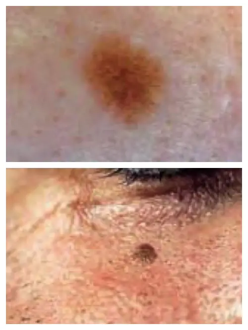 dark spots on skin pictures