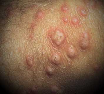 pictures of folliculitis on legs