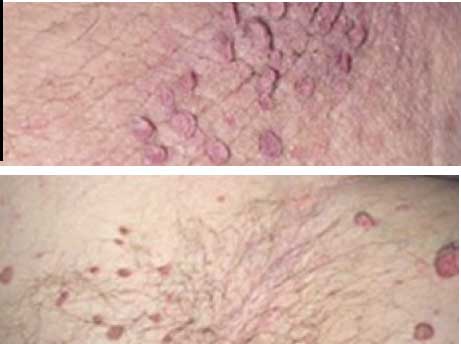 groin skin tags pictures