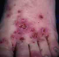 skin infection on foot