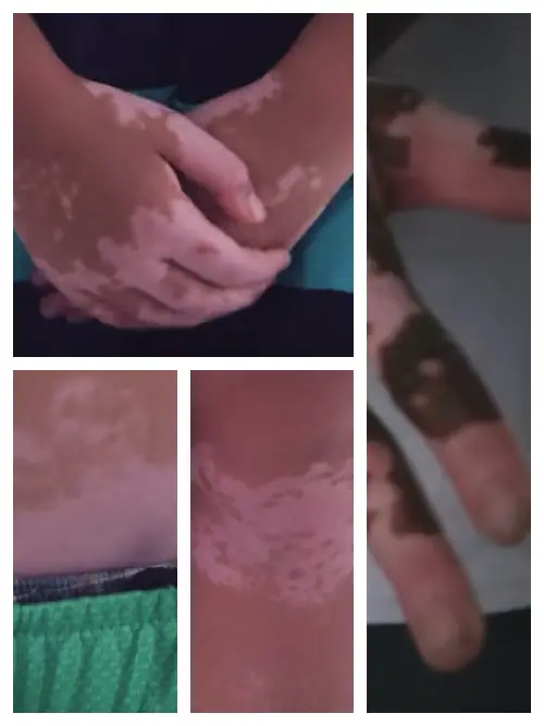 vitiligo pictures