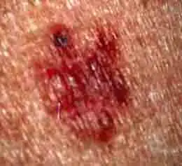 itchy skin bumps