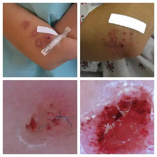 4 morgellons pictures