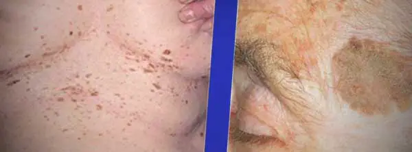 brown spots on skin pictures